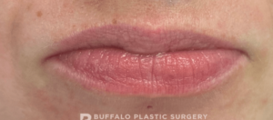 Lip Fillers Before and After Pictures in Buffalo, NY