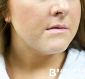 Lip Fillers Before and After Pictures in Buffalo, NY