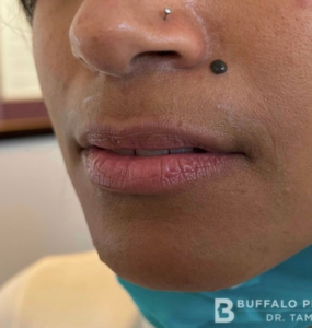 Lip Fillers Before and After Pictures in Buffalo, NY