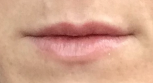 Lip Fillers Before and After Pictures in Buffalo, NY