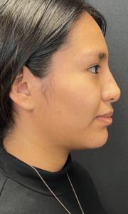 Liquid Rhinoplasty Before and After Pictures in Buffalo, NY