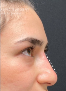 Liquid Rhinoplasty Before and After Pictures in Buffalo, NY