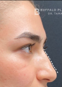 Liquid Rhinoplasty Before and After Pictures in Buffalo, NY
