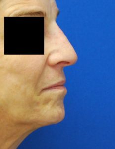 Rhinoplasty (Nose Surgery) Before and After Pictures Buffalo, NY