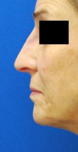 Rhinoplasty (Nose Surgery) Before and After Pictures Buffalo, NY