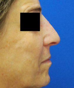 Rhinoplasty (Nose Surgery) Before and After Pictures Buffalo, NY