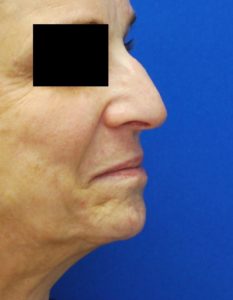 Rhinoplasty (Nose Surgery) Before and After Pictures Buffalo, NY