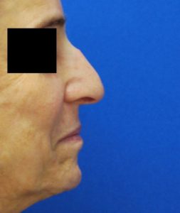 Rhinoplasty (Nose Surgery) Before and After Pictures Buffalo, NY