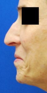 Rhinoplasty (Nose Surgery) Before and After Pictures Buffalo, NY