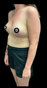 Mastopexy (Breast Lift) Before and After Pictures in Buffalo, NY