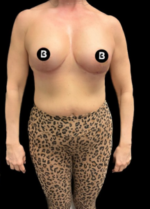 Mastopexy (Breast Lift) Before and After Pictures in Buffalo, NY