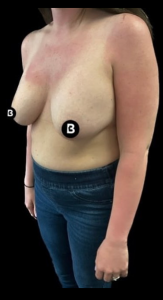 Mastopexy (Breast Lift) Before and After Pictures in Buffalo, NY