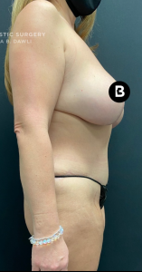 Mommy Makeover Before and After Pictures in Buffalo, NY
