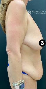 Mommy Makeover Before and After Pictures in Buffalo, NY