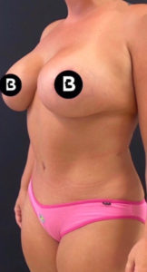 Mommy Makeover Before and After Pictures in Buffalo, NY