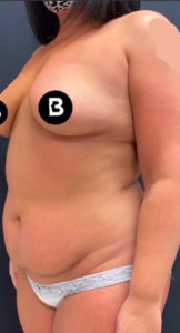 Mommy Makeover Before and After Pictures in Buffalo, NY
