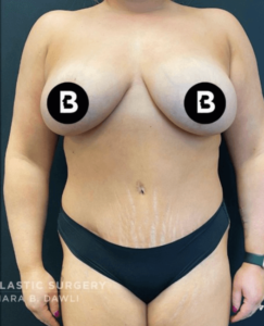Mommy Makeover Before and After Pictures in Buffalo, NY