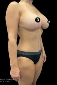 Mommy Makeover Before and After Pictures in Buffalo, NY