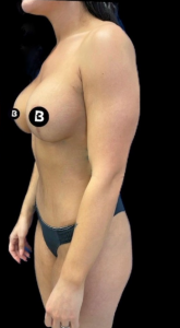 Mommy Makeover Before and After Pictures in Buffalo, NY