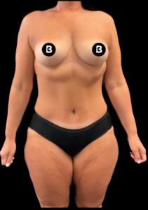 Mommy Makeover Before and After Pictures in Buffalo, NY