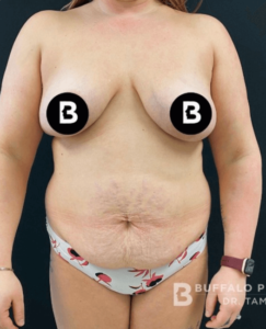 Mommy Makeover Before and After Pictures in Buffalo, NY
