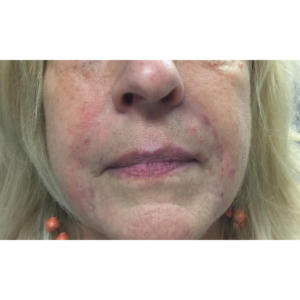 Facial Fillers Before and After Pictures in Buffalo, NY