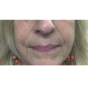 Facial Fillers Before and After Pictures in Buffalo, NY