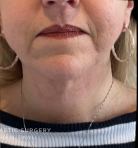 Necklift Before and After Pictures in Buffalo, NY