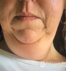 Necklift Before and After Pictures in Buffalo, NY