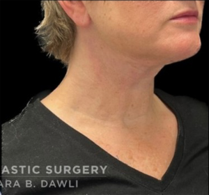 Necklift Before and After Pictures in Buffalo, NY