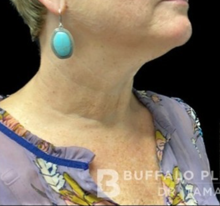 Necklift Before and After Pictures in Buffalo, NY