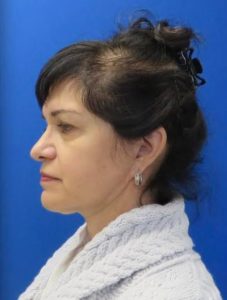 Necklift Before and After Pictures Buffalo, NY