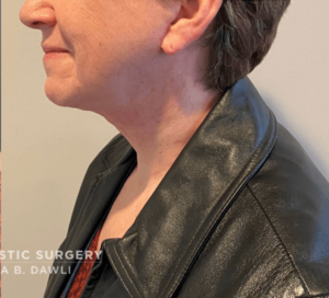Necklift Before and After Pictures in Buffalo, NY