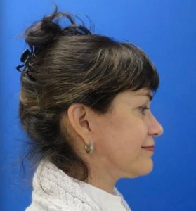 Necklift Before and After Pictures Buffalo, NY
