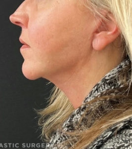 Necklift Before and After Pictures in Buffalo, NY