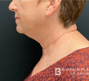 Necklift Before and After Pictures in Buffalo, NY