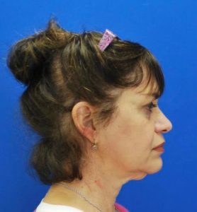 Necklift Before and After Pictures Buffalo, NY