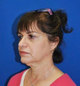 Necklift Before and After Pictures Buffalo, NY