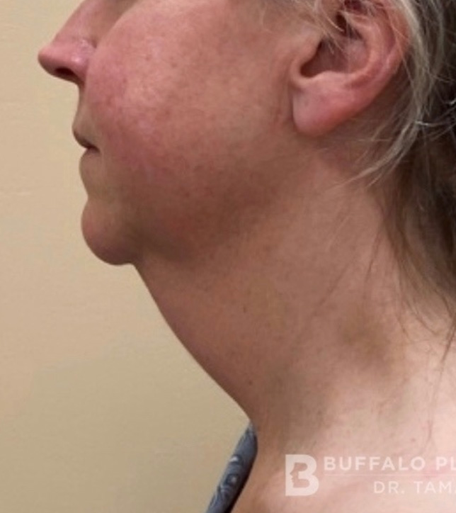 Necklift Before and After Pictures in Buffalo, NY