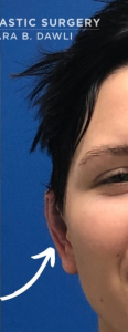 Otoplasty Before and After Pictures Buffalo, NY