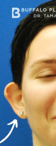 Otoplasty Before and After Pictures Buffalo, NY