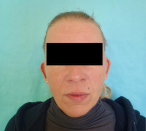 Otoplasty Before and After Pictures Buffalo, NY