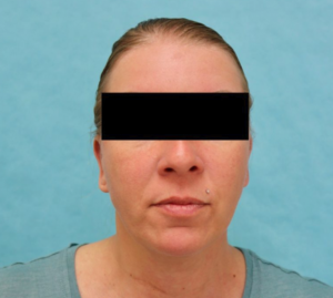 Otoplasty Before and After Pictures Buffalo, NY