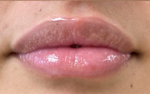 Lip Augmentation Before and After Pictures Buffalo, NY