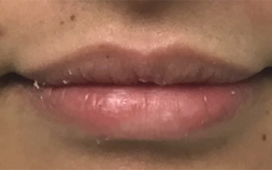 Lip Augmentation Before and After Pictures Buffalo, NY