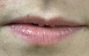 Lip Augmentation Before and After Pictures Buffalo, NY