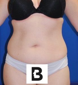 Liposuction Before and After Pictures Buffalo, NY