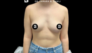 Breast Reduction Before and After Pictures in Buffalo, NY