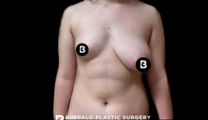 Breast Reduction Before and After Pictures in Buffalo, NY