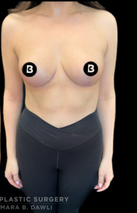 Breast Reduction Before and After Pictures in Buffalo, NY